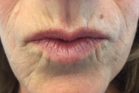 Lines and Wrinkles on the Upper Lip and Around the Mouth Explained – Caci