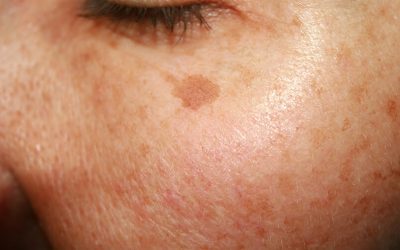 ZO Newsletter – What is Hyperpigmentation