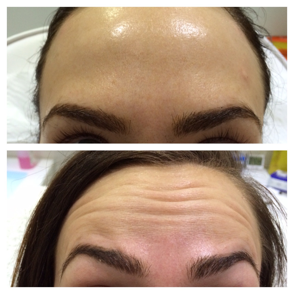 Forehead And Frownlines True You Skin Clinics