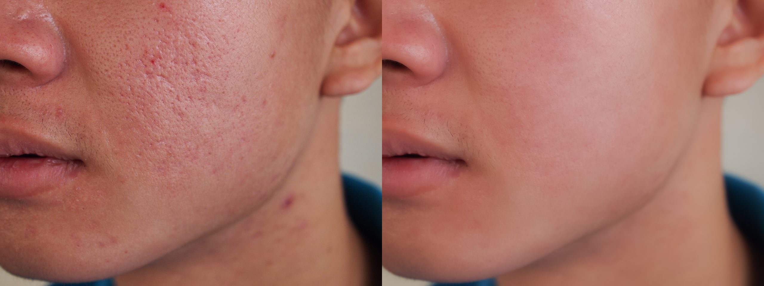 Acne Scarring True You Skin Clinics