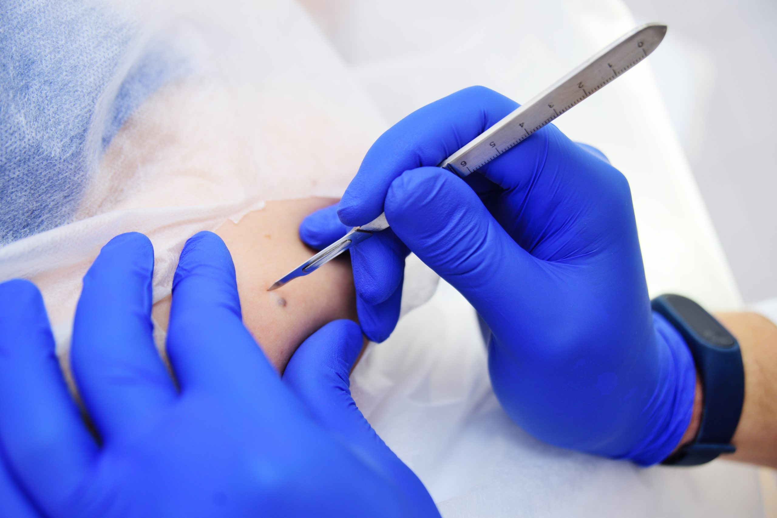 Medical,Surgical,Treatment,Removal,Of,A,Mole,On,The,Hand